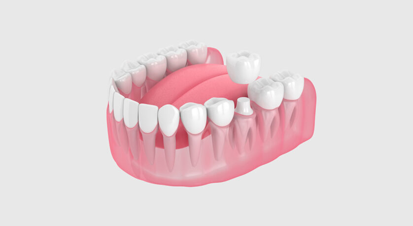 Can an Implant Crown Be Replaced?