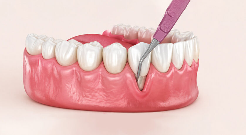 Common Periodontal Treatments for Gum Diseases