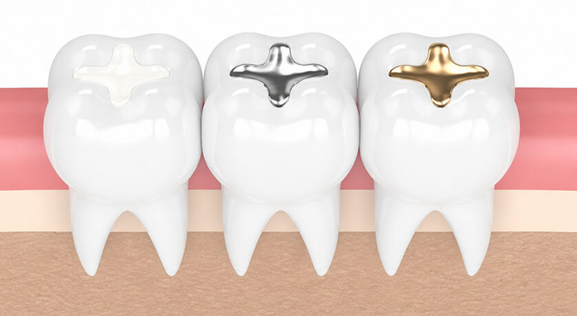 Dental Filling Removal and Replacement: What You Should Know?