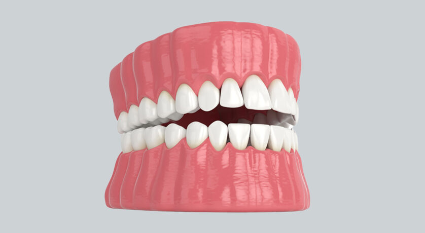 Full Mouth Dentures