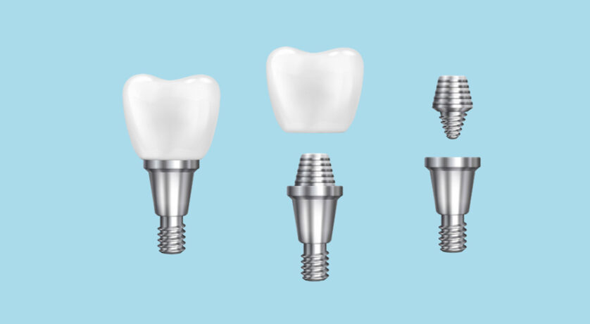 How Long Do I Have to Wait to Get Implants After Tooth Removal?