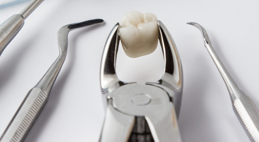 How Many Teeth Can Be Extracted at Once?