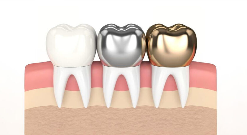 How Porcelain Inlays & Onlays Can Repair Your Damaged Teeth?