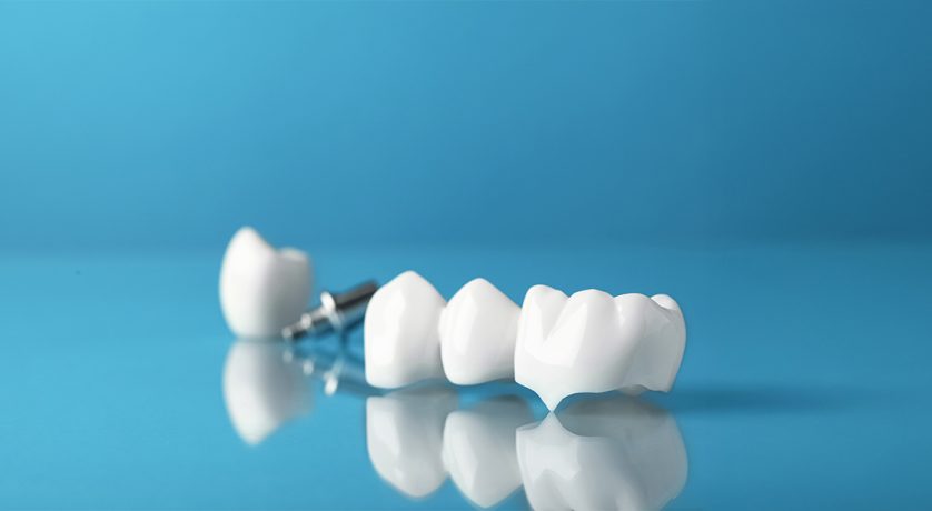 How Same-Day Crowns In Encinitas Save Time And Restore Your Smile Faster?