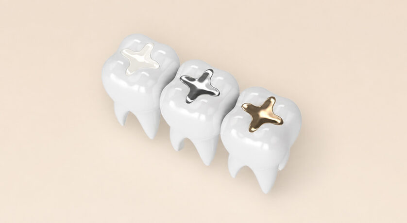 How Tooth-colored Fillings Offer a Perfect Alternative to Dental Amalgam