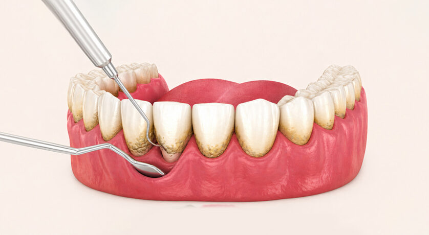 Periodontal Treatment 101: Everything You Need to Know