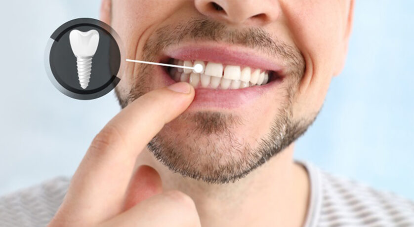 Sinclair Smiles- Replacement Techniques of Dental Implant Crowns