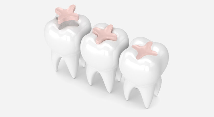 What Are the Pros and Cons of Composite Dental Fillings?