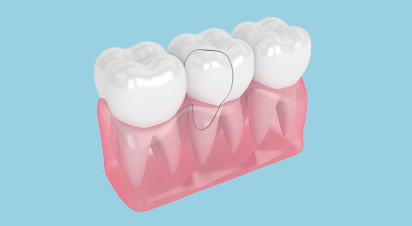 What Does a Cracked Dental Crown Feel like?